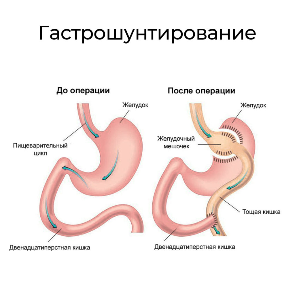 Кишечный цикл. Мини гастрошунтирование желудка. Гастрошунтирование желудка схема операции. Операция мини гастрошунтирование желудка. Гастрошунтирование желудка по ру.